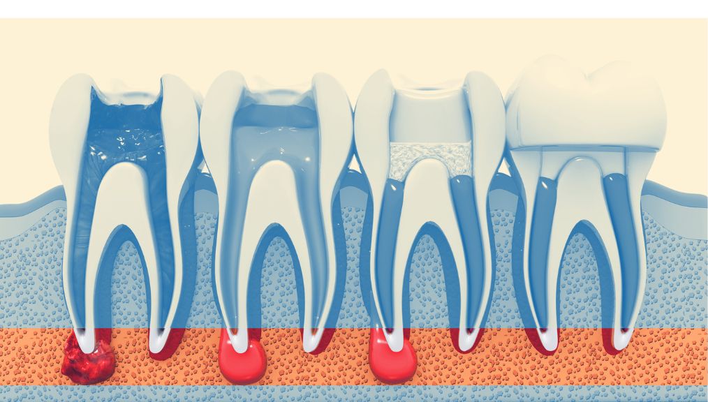 root-canal-dentist-central-alberta