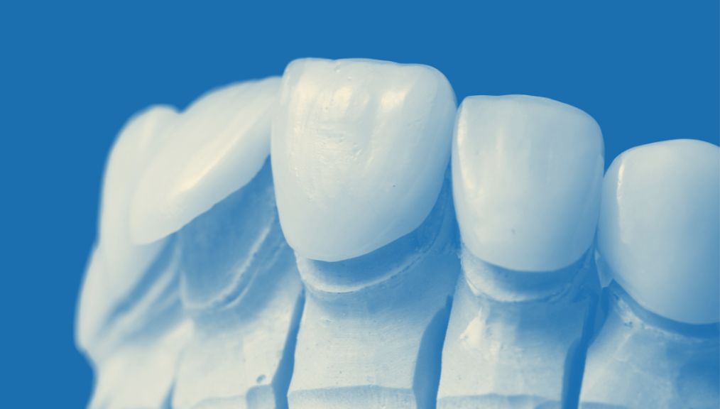 dental-veneers-dentist-central-alberta