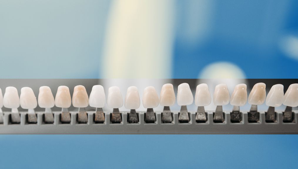 dental-veneers-dentist-in-alberta