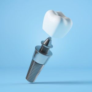 implant-dentist-alberta