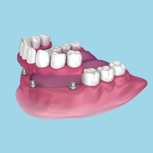 implant-dentist-in-alberta