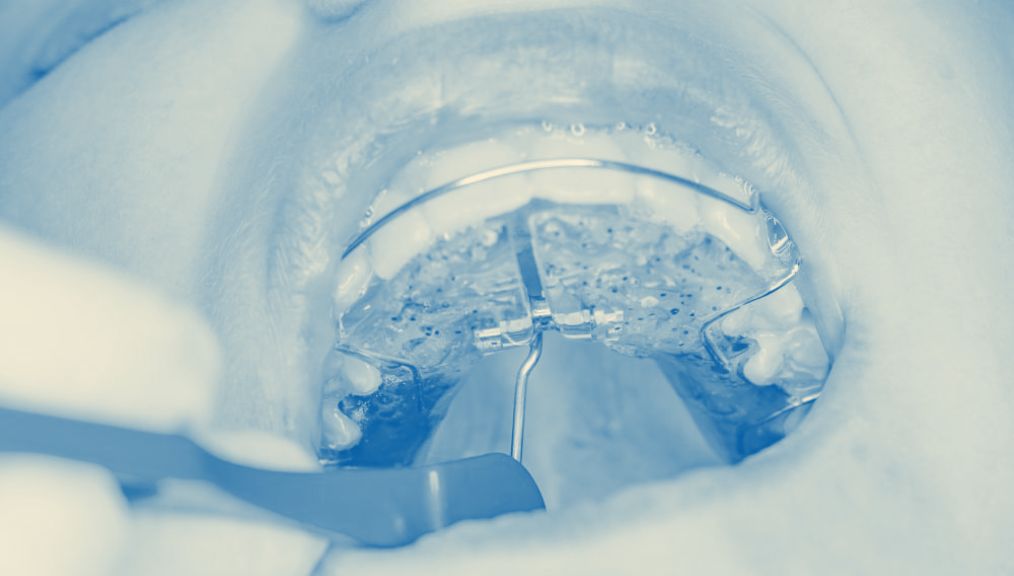 palatal-expander-kids-dentist-central-ab