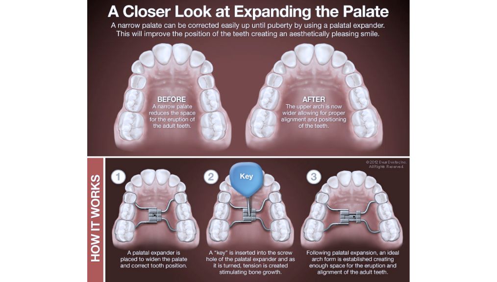 palatal-expansion-children-dentist-central-ab