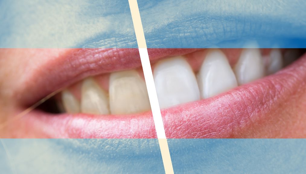 teeth-whitening-alberta-bentley